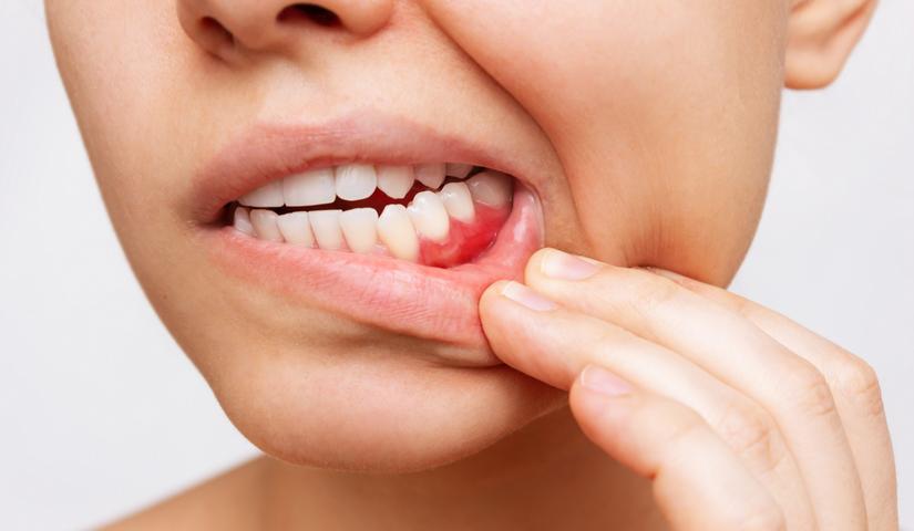Gyakran vérző fogíny, romló fogak: így növelhetik a daganat esélyét