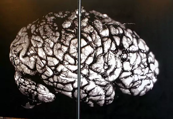 W jaki sposób fałduje się mózg? Naukowcy zaskoczeni wynikami eksperymentu