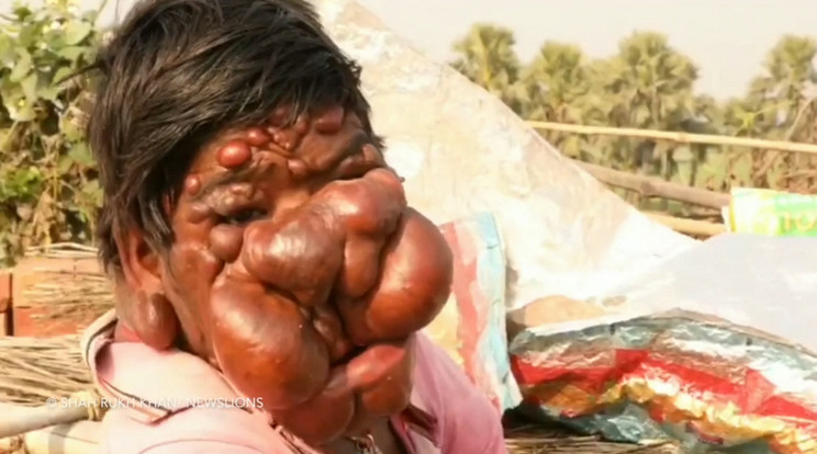 Az indiai Mithun Chauhannak hatalmas tumorokkal volt tele az arca /Fotó: Northfoto