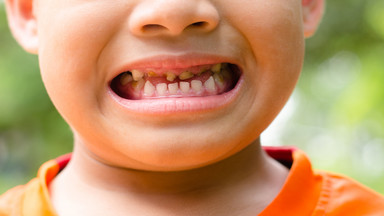 Fatalny stan zębów dzieci w Polsce