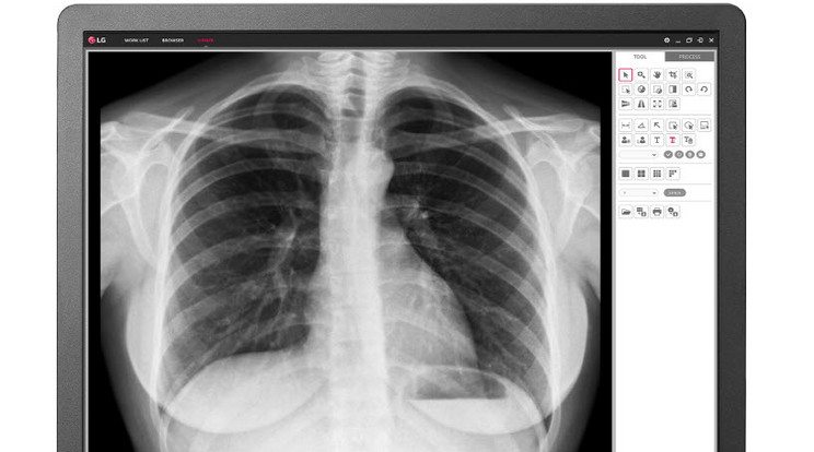 A gyógyászati megtekintő monitor / Fotó: LG