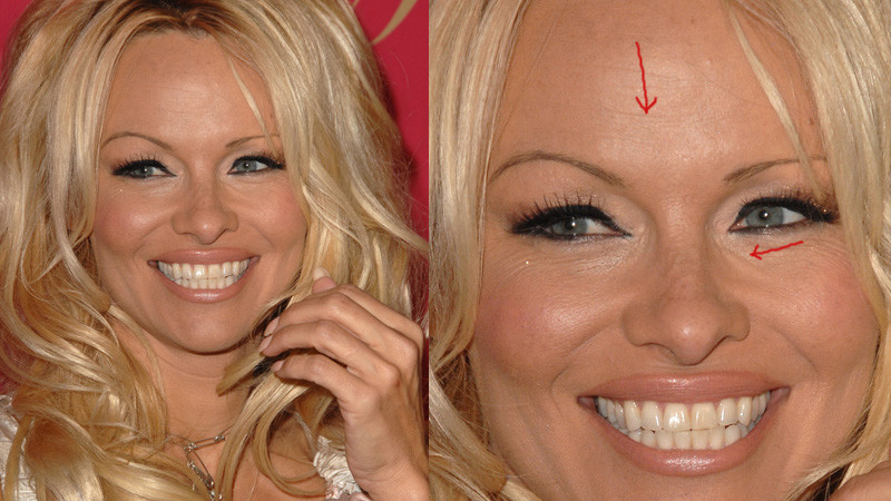 Pamela Anderson wstrzykuje sobie BOTOKS