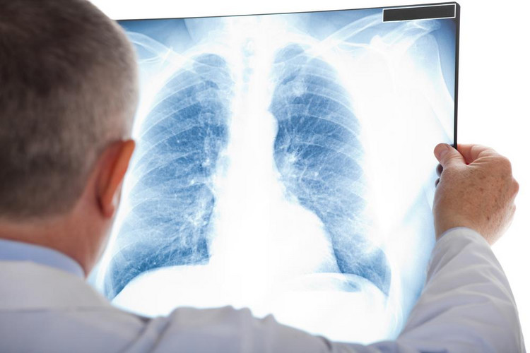 Zapalenie płuc wywołane przez pneumokoki