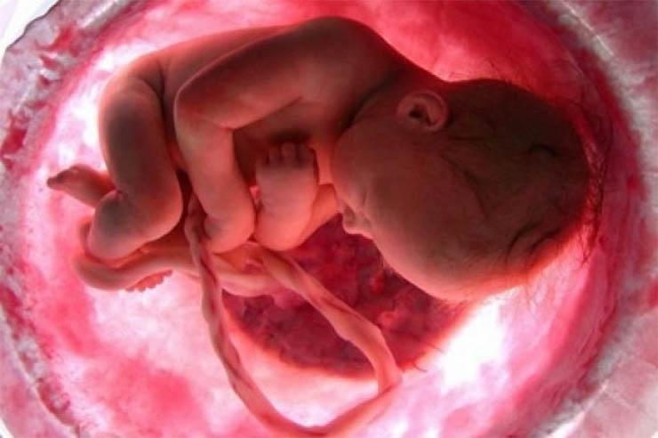 Ez a kisbaba kétszer született meg, és ennek köszönheti az életét