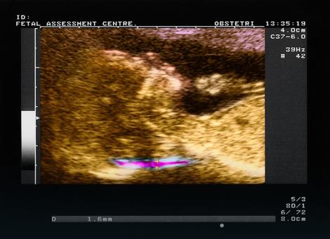 Skeniranje potiljka fetusa radi detektovanja abnormalnosti