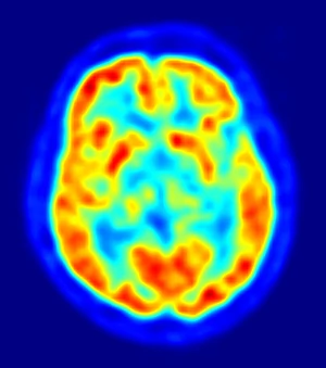 Radioaktywna glukoza pozwala obserwować pracę mózgu