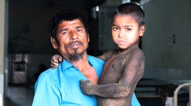 Ez a bangladesi fiú egy ritka bőrbetegségben szenved / Fotó: Northfoto