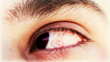 Choroby oczu związane z pracą przy komputerze: syndrom widzenia komputerowego, zespół rzadkiego mrugania
