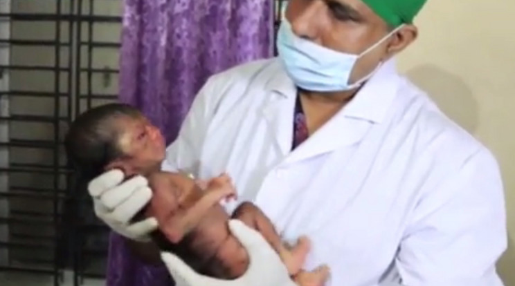 Ritka betegségben szenved a bangladesi kisfiú