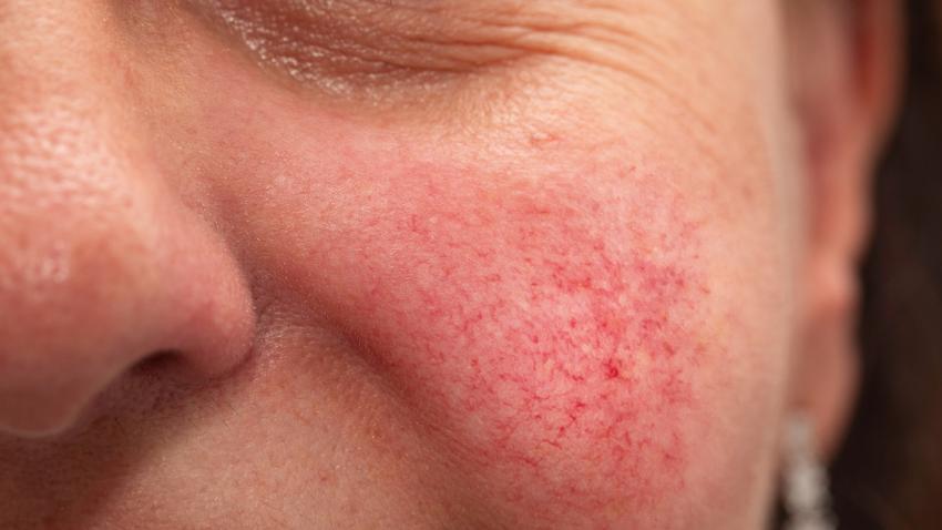 piros arcbőr oka autoimmun betegség lupus tünete