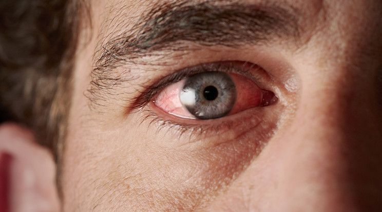 Ha bevérzést tapasztalunk a szemünkön, érdemes orvoshoz fordulni a problémával /Fotó: Shutterstock