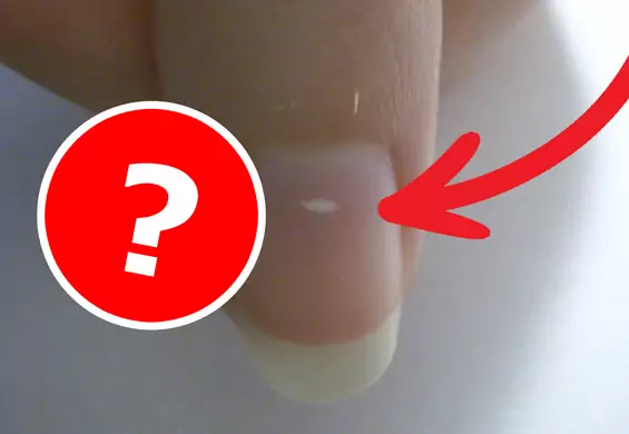 Czym są i skąd się biorą białe plamki na paznokciu?