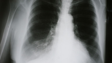 Witamina D łagodzi objawy przewlekłej choroby płuc (POChP)