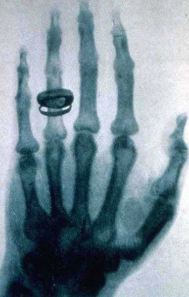 Rentgenowskie zdjęcie dłoni Rudolfa Kollikera, które Wilhelm Roentgen wykonał 23 stycznia 1896 roku. fot. Wikimedia Commons.