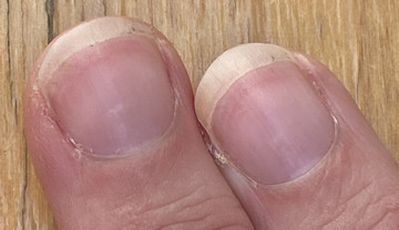 Objawy cukrzycy widać na paznokciach. Mały szczegół może być znaczący
