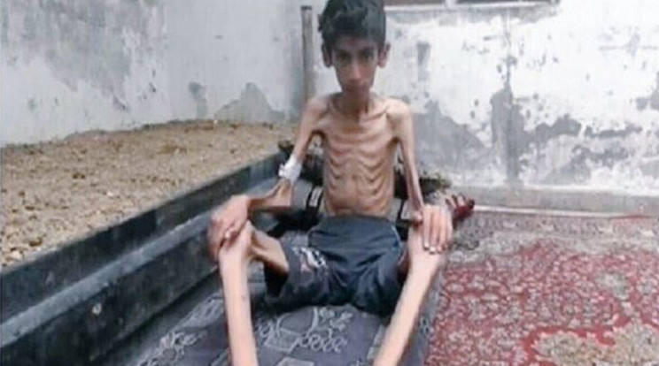 Ez a tizenéves szíriai fiú szó szerint csont és bőr / Fotó: Twitter