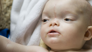 Chłopiec urodzony z mózgiem na zewnątrz cudem ocalony dzięki interwencji chirurgów