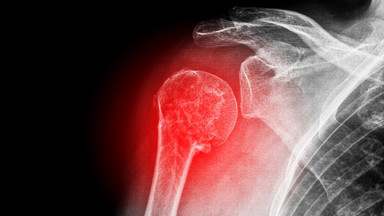 Osteoporoza to "cicha złodziejka kości" - jak się przed nią obronić?