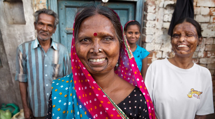 Indiai nők élik úgy mindennapi életüket, hogy arcuk teljesen eldeformálódott / Fotó: Profimedia-Reddot