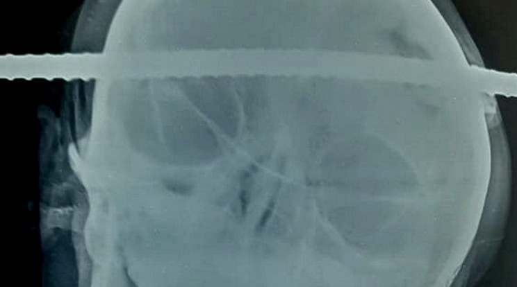 Röntgenfelvétel az átszúrt koponyáról / Fotó: Northfoto