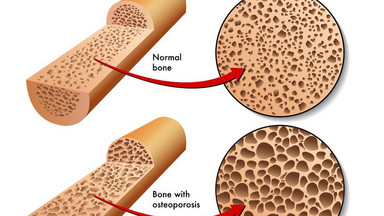 Dieta w osteoporozie. Fakty i mity