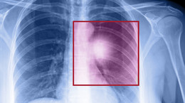 Rak płuc - jakie objawy powinny zaniepokoić? Jakich symptomów nie lekceważyć?