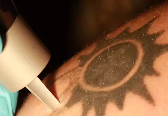 Zobacz z bliska, jak laser w zaledwie kilka sekund usuwa prawdziwy tatuaż