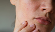 Grzybica skóry — objawy. Jak wygląda leczenie grzybicy skóry?