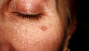 Zaburzenia barwnikowe skóry - rodzaje, objawy i leczenie