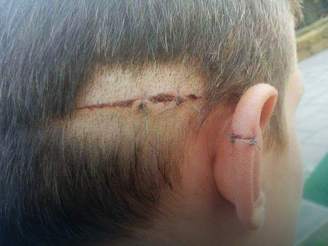 Povreda na glavi maloletnog S.S.