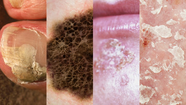 9 typowych chorób skóry