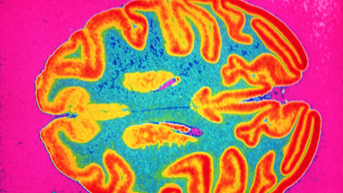 W niektórych przypadkach choroba Alzheimera może przenosić się między ludźmi. Zapytaliśmy eksperta, czy są powody do obaw