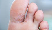  Reinfekcja po grzybicy stóp - dlaczego walka z grzybicą jest taka trudna? 