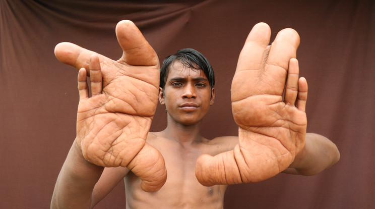 Egy rejtélyes betegség miatt ennek a fiúnak a kezei elképesztő módon megnőttek /Fotó: Northfoto