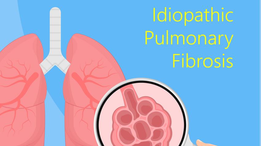 idiopátiás tüdőfibrózis, IPF, tünetei, kezelése, diagnosztizálása, köhögés