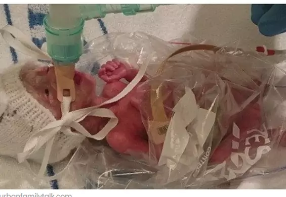 Nietypowa, ale skuteczna akcja ratowania wcześniaka: lekarze tuż po porodzie włożyli go do worka na kanapki