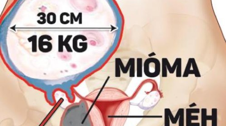 16 kilós daganatot operáltak ki a nőből