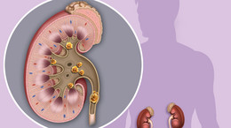 Objawy, które świadczą o tym, że masz złogi w nerkach