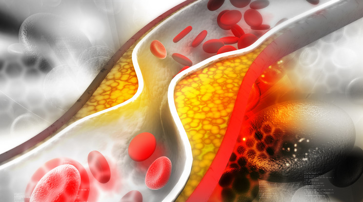 A magas koleszterin-szint növeli az érelmeszesedés rizikóját/ Illusztráció: Shutterstock