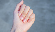  Prążki na paznokciach - czy są objawem choroby lub niedoboru witamin? 