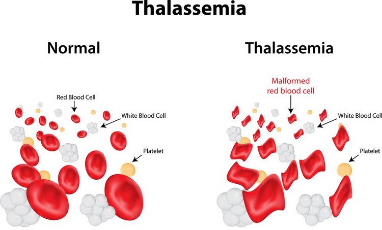 Talasemia