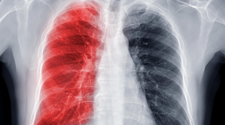 Itt van 10 meglepő tény a tbc-ről / Illusztráció: Northfoto