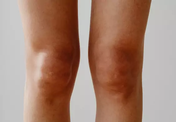 Twoje łokcie i kolana wyglądają, jakby były brudne? To może być objaw tych trzech chorób