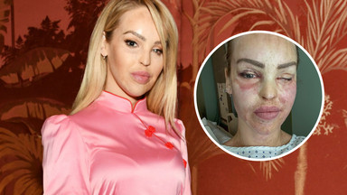 Katie Piper przeszła kolejną operację. Lekarze ratowali jej oko