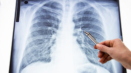 Grzybica płuc - sposób zakażenia, objawy, leczenie
