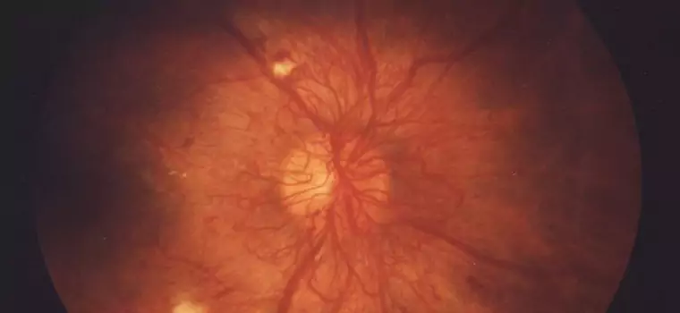 Sztuczna inteligencja będzie wykrywać retinopatię cukrzycową