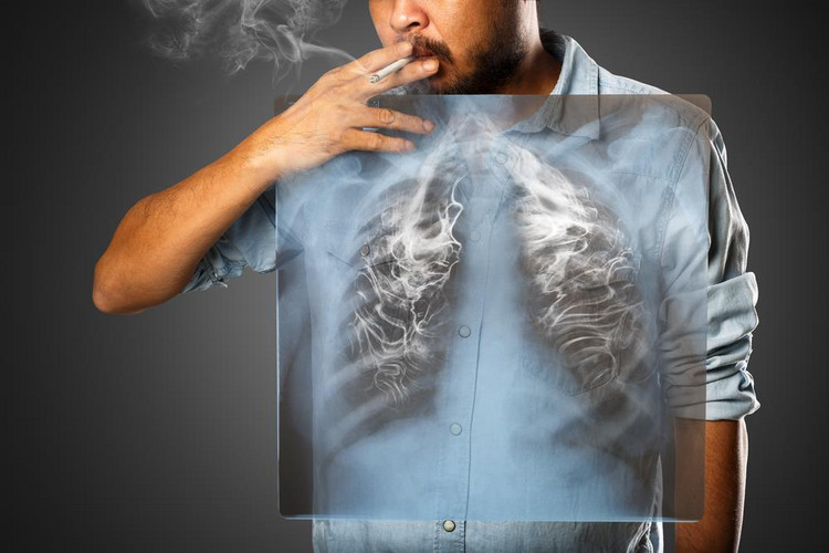Na raka płuca chorują głównie mężczyźni. MIT