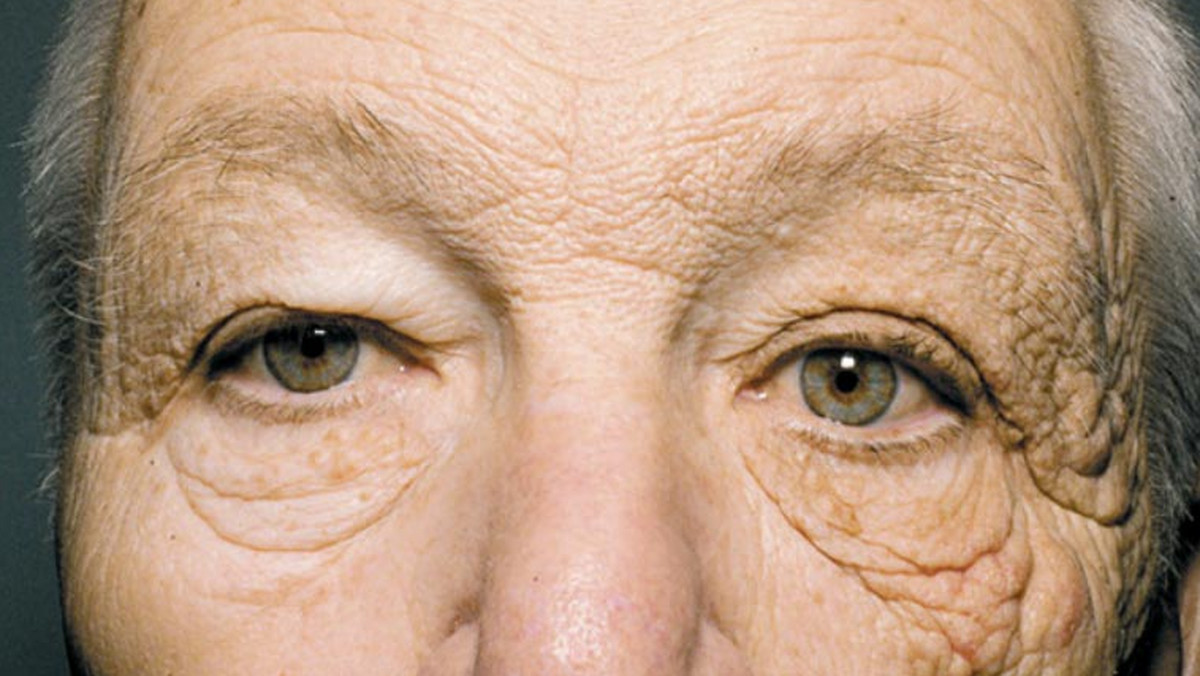 69-letni Grek przez 28 lat pracował w swoim upalnym kraju jako kierowca wozu dostawczego, więc promienie słoneczne częściej oświetlały lewą połowę jego twarzy. Rezultat działania promieni ultrafioletowych widać gołym okiem: połowa oblicza mężczyzny wygląda na starszą o 20 lat.