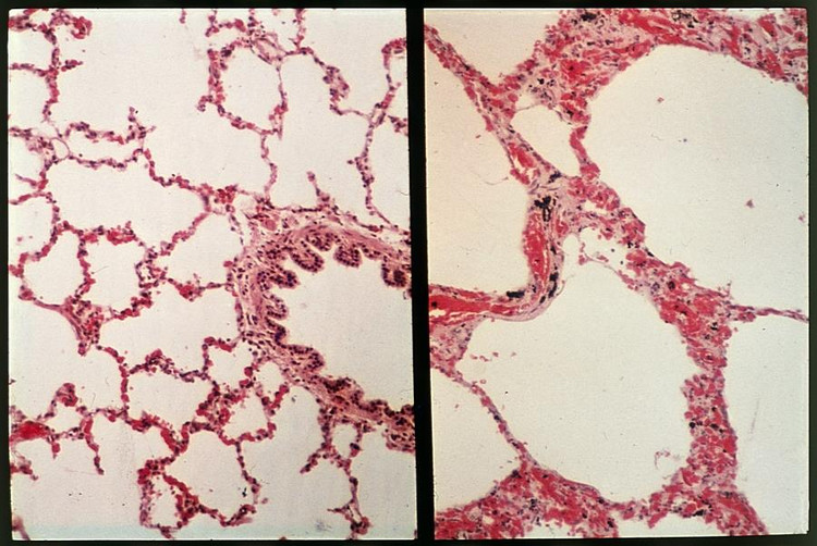 Obraz mikroskopowy płuc