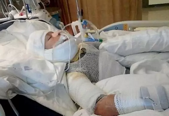 Autystyczny 10-latek trafił do szpitala z poważnymi poparzeniami. Matka: podpalili go koledzy